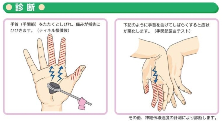 「手のしびれ【手根管症候群】の診断と治療」