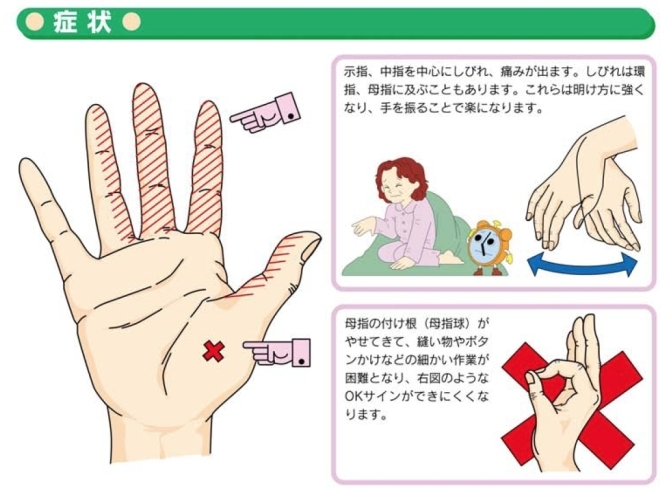 「手のしびれ【手根管症候群】の症状と原因」