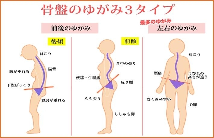 「骨盤のゆがみはからだの不調の原因に…」