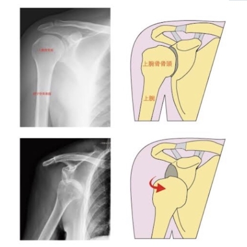 「肩関節脱臼の応急処置」
