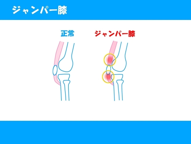 「膝に起こる症状（一例）【ジャンパー膝】」