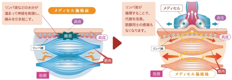 「『筋膜療法』って知っていますか？( *´艸｀)」