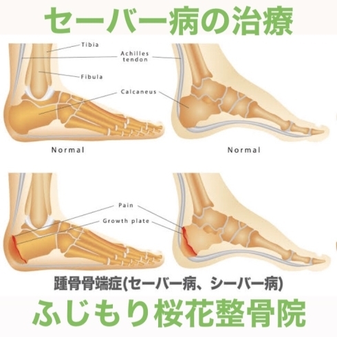 「セーバー病の治療は八王子、ふじもり桜花整骨院で。」