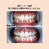 確認ホワイトニング ホワイトニング前後の歯の色の変化を確認する方法 - 南青山矯正歯科