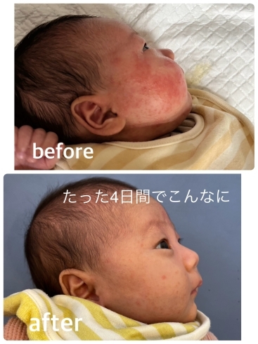 孫の乳児湿疹がたった4日間でこんなに改善「たった4日間でこんなに！！」
