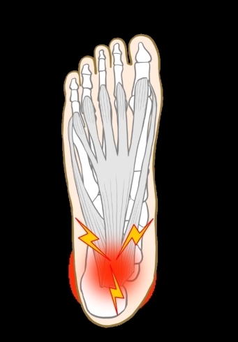 足底筋膜炎「足裏や踵の痛み」