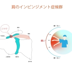 肩のある角度での痛みや痺れ・肩インピンジメント