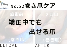 No.52巻き爪ケア「矯正中でも出せる爪」