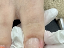 【松江ネイル】巻き爪になっていませんか？NailSalon花糸撫子