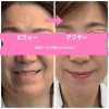 プラズマペン　繰り返すニキビ肌に　肌荒れに　業務用・セルフok プラズマペン 繰り返すニキビ肌に 肌荒れに 業務用・セルフok