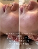 フォトとハーブピーリングで内側から美しい肌に。ハイドラ毛穴洗浄×光