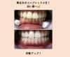 黄ばみのコンプレックスを解消し、白い歯へ✨ | WHITENING CARE