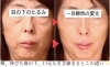 目の下のたるみ、頬のたるみ、口元のたるみ、あらゆるたるみに効果抜群