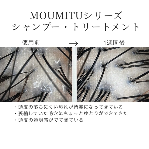 MOUMITUシリーズを使えば髪も頭皮も健やかに☆「【将来の髪の毛のためのケア✨】薄毛は気にならないけど「ハリコシはなくなってきたな〜」と感じている方！！コレを使って、本当に変わっていくところを目で見て実感しませんか？😍」