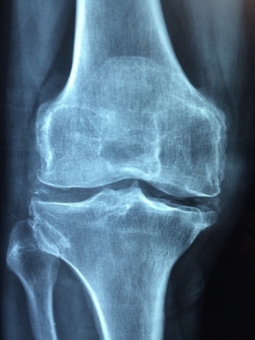 膝の健康な関節画像です。痛みをなくしましょう！「９月入会のご案内【膝痛改善！加圧パーソナルトレーニングジムスタイル】」
