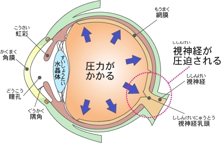 「緑内障・眼圧異常の改善体験記」