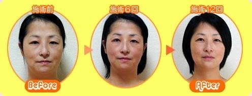 美顔矯正「小顔になりたい方!!　必見!!　初回割引で半額!!」