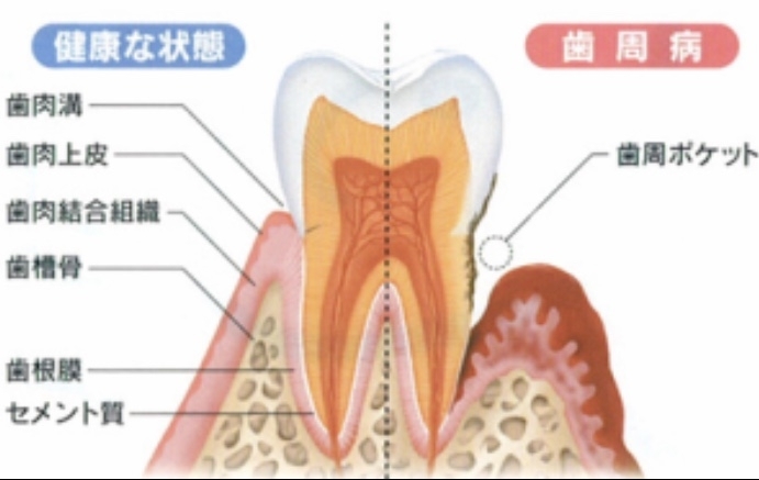 「八王子市歯周病検診」