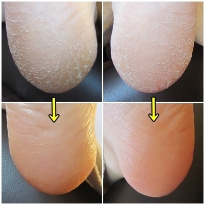 「ドイツ式フットケアでキレイで健康な足へ」