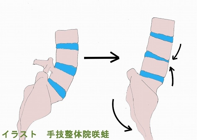 図３「ヘルニアは腰痛の原因ではない」