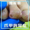 No.81あーこれ巻き爪じゃなくて爪甲鉤彎症３「No.81あーこれ巻き爪じゃなくて爪甲鉤彎症なんですよ」