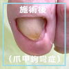 No.56病院で断られた爪甲鉤彎症のケア４「No.56病院で断られた爪甲鉤彎症のケア」