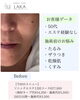 「ほうれい線とたるみの変化をわかりやすく＊ソニックエステ12回の施術例」