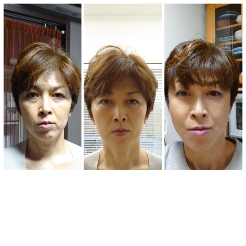 ハイフからの小顔コルギからのプラズマ最強小顔 美肌コーススタート グラ モーレのニュース まいぷれ 松江 ハイフからの小顔コルギからのプラズマ最強小顔 美肌コーススタート グラ モーレのニュース まいぷれ 松江