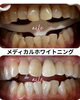 「ホワイトニングと差し歯の色をそろえて、口元をトータルチェンジ」