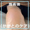 No.53かかとケアの施術事例４「No.53かかとケアの施術事例」