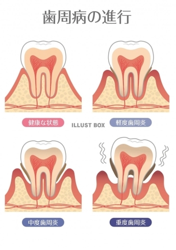 歯周病が進む前に早めにチェック、早めに治療です。「「歯」は身体に何か影響を及ぼすのでしょうか…？今日は「歯周病と健康」についてお話します。」