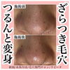 ビフォーアフター「毛穴の詰まり、開き、黒ずみ、ニキビに悩んでいませんか？？」