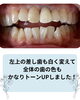 「ホワイトニングと差し歯の色をそろえて、口元をトータルチェンジ」
