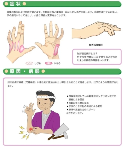 「手のしびれ２【肘部管症候群】症状と原因」
