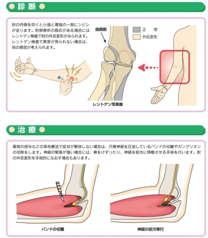 ストレッチ 管 症候群 肘 部 肘部管症候群の施術