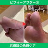 劇的解消！角質ケア①「劇的解消！角質ケアのビフォーアフター【外反母趾や巻き爪、足の悩み専門整体/千葉県船橋市西船徒歩2分】」