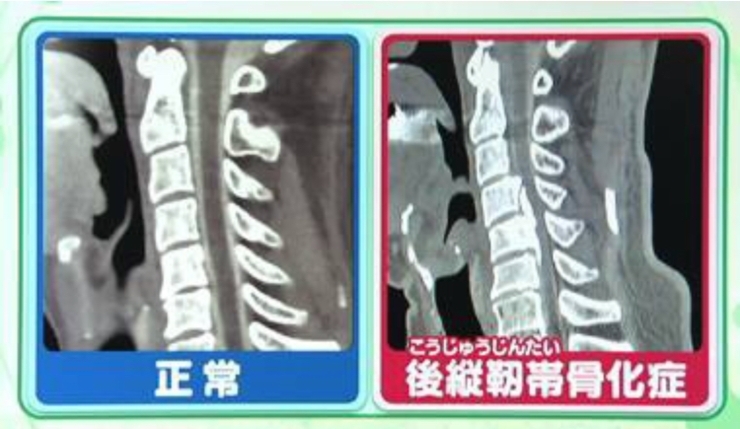 「後縦靭帯骨化症」