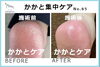 かかと集中ケア２「「夏のサンダル向け」かかと集中ケア　No.92 」