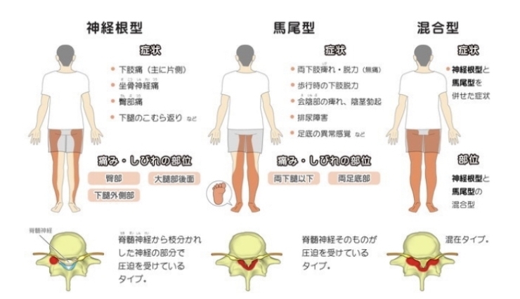 「脊柱管狭窄症の種類」