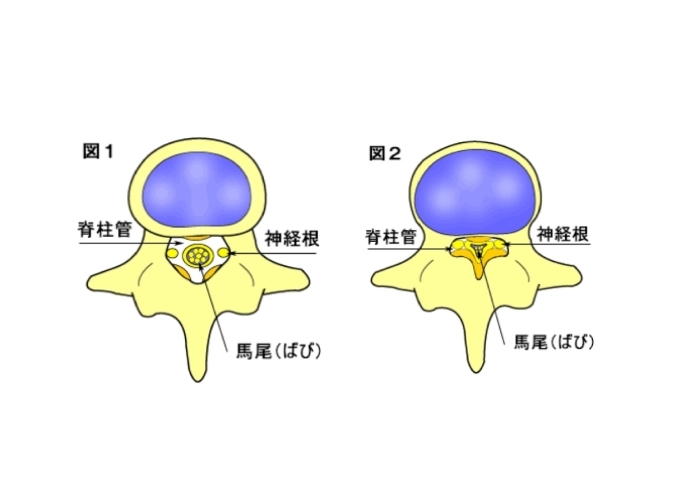 「施術紹介：脊柱管狭窄症（腰部脊柱管狭窄症）」