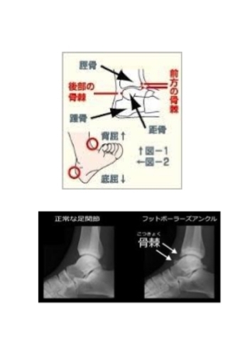 「施術紹介：フットボーラーズアンクル（footballer’s ankle）」