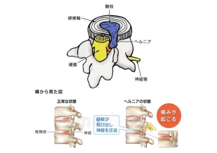 「施術紹介：腰椎椎間板ヘルニア」