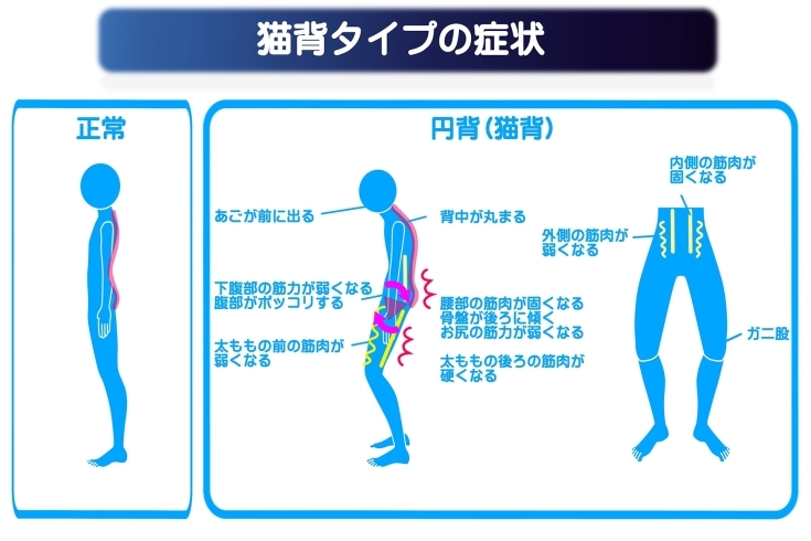 「猫背の種類【猫背タイプの症状】」