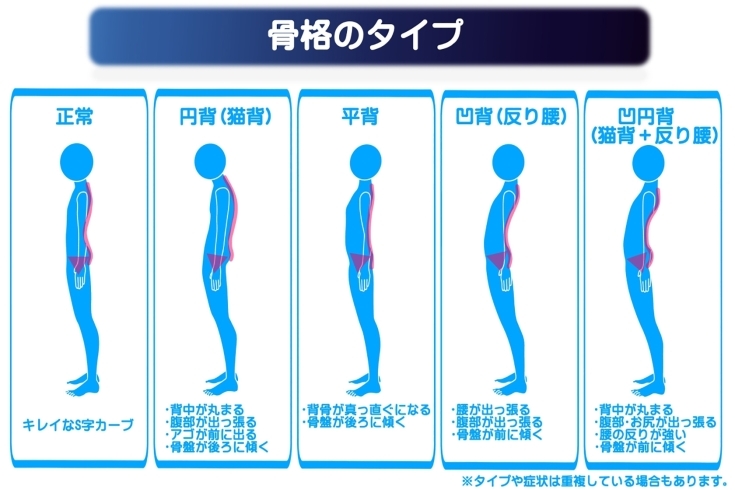 「猫背の種類【骨格のタイプ】」