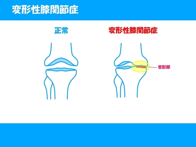 「膝に起こる症状（一例）【変形性膝関節症】」
