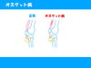 「膝に起こる症状（一例）【オスグット病】」