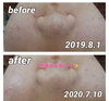 「エステ✴︎before•after✴︎」