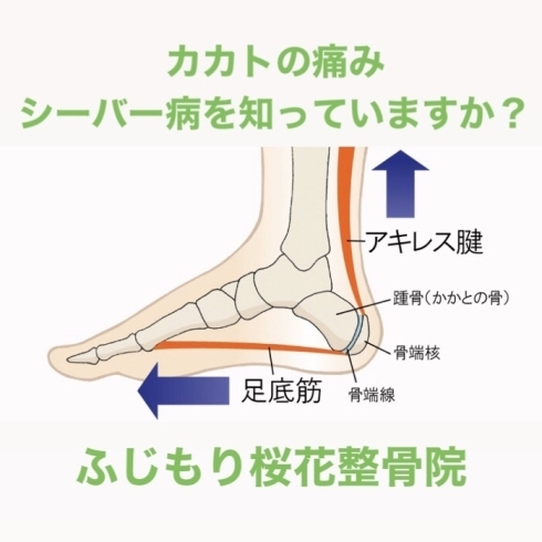 「かかとの痛み、シーバー病を八王子のふじもり桜花整骨院で治療する」