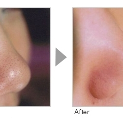 毛穴ケア 1回でも効果実感 esthe salon plum エステサロン プラム のニュース まいぷれ 出雲