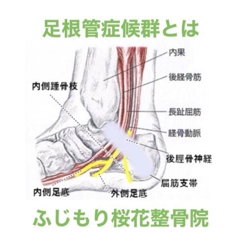 「足根管症候群を治療するならふじもり桜花整骨院」